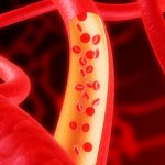 Цереброваскулярная болезнь